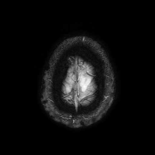 Cerebral cavernous venous malformation (Zabramski type II) (Radiopaedia 85511-101198 Axial SWI 109).jpg
