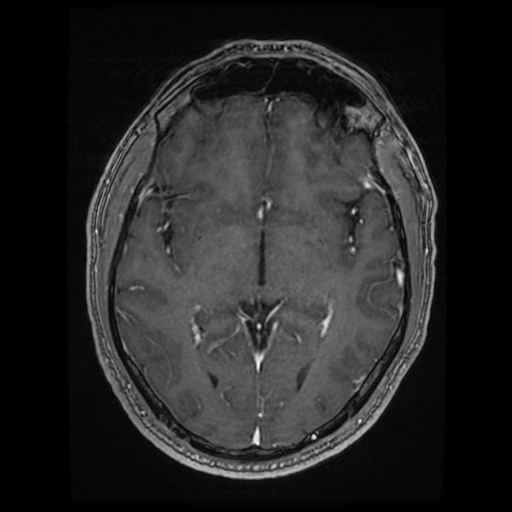 Cerebral cavernous venous malformation (Zabramski type II) (Radiopaedia 85511-101198 Axial T1 C+ fat sat 47).jpg
