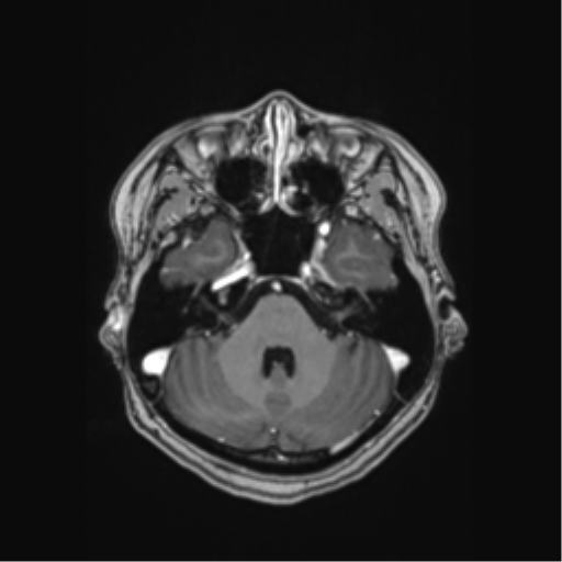 Cerebral cavernous venous malformations (Radiopaedia 48117-52946 Axial T1 C+ 11).png