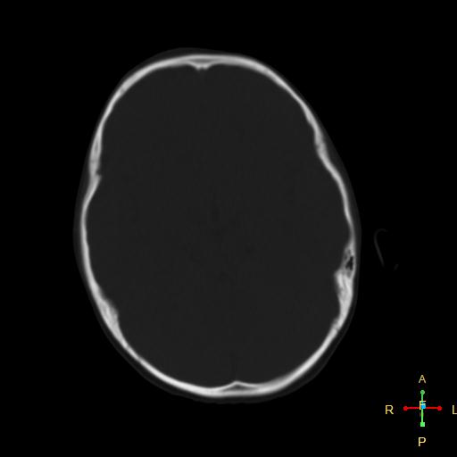 File:Cerebral contusion (Radiopaedia 48869-53911 Axial bone window 13).jpg