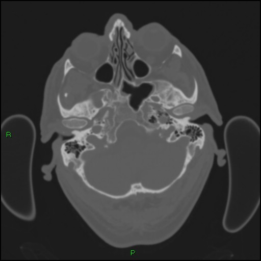 File:Cerebral contusions (Radiopaedia 33868-35039 Axial bone window 30).jpg