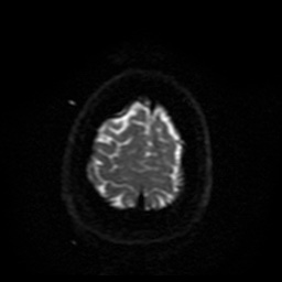 Cerebral embolic infarcts (embolic shower) (Radiopaedia 49837-55108 Axial DWI 5).jpg