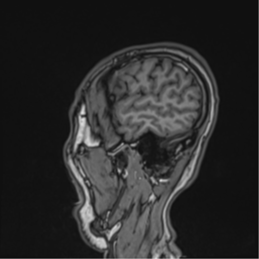 Cerebral fat embolism (Radiopaedia 57697-64639 Sagittal T1 13).png