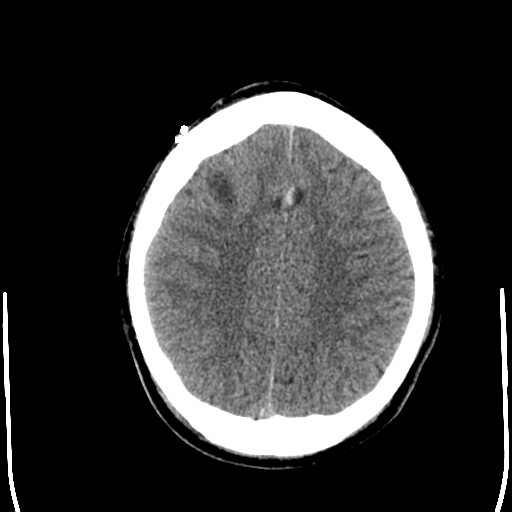 File:Cerebral hemorrhagic contusions- temporal evolution (Radiopaedia 40224-42754 Axial non-contrast 22).png