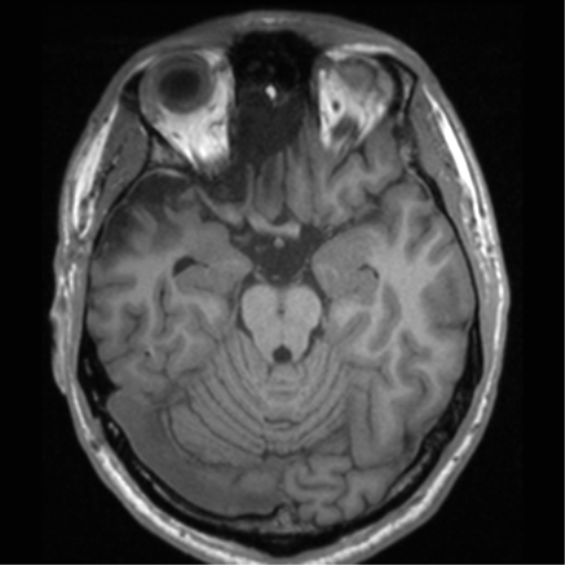 Cerebral hemorrhagic contusions- temporal evolution (Radiopaedia 40224-42757 Axial T1 28).png