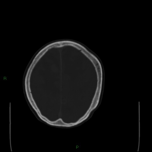 Cerebral metastases - breast primary (Radiopaedia 77653-89857 Axial bone window 92).jpg