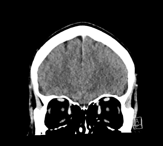Cerebral metastases - testicular choriocarcinoma (Radiopaedia 84486-99855 D 15).jpg