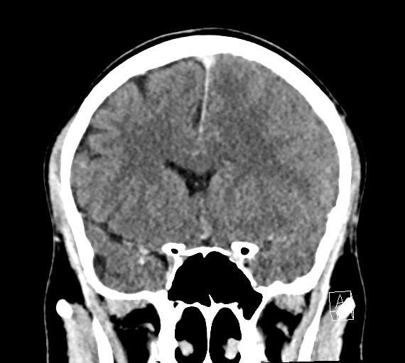 Cerebral metastases - testicular choriocarcinoma (Radiopaedia 84486-99855 D 24).jpg