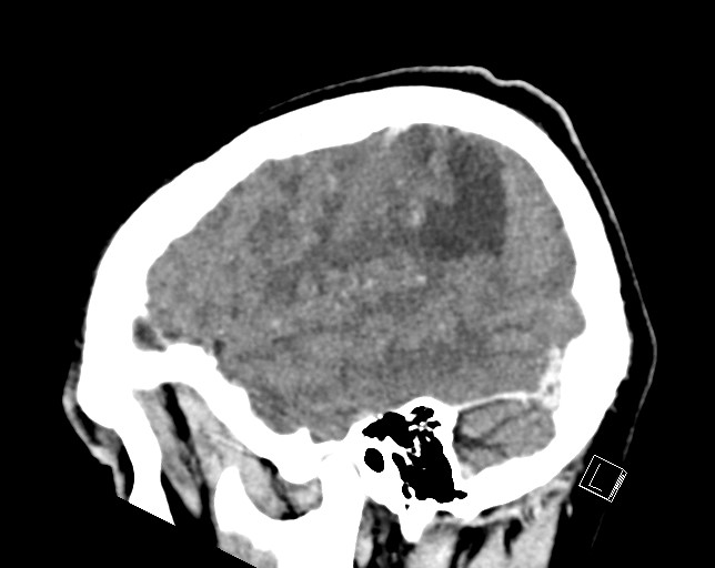 Cerebral metastases - testicular choriocarcinoma (Radiopaedia 84486-99855 F 14).jpg