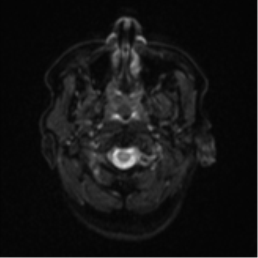Cerebral metastases mimicking abscesses (Radiopaedia 45841-50131 Axial DWI 2).png