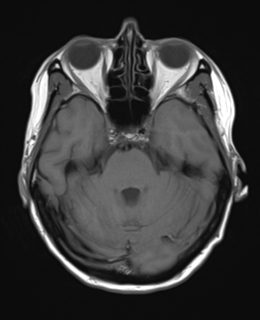 File:Cerebral metastasis (Radiopaedia 46744-51248 Axial T1 8).png