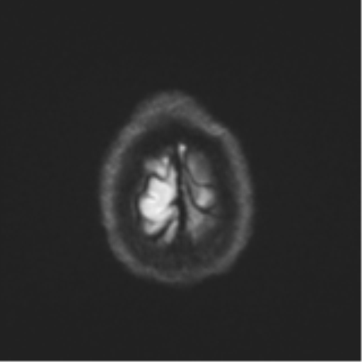 Cerebral metastasis - melanoma (Radiopaedia 54718-60954 Axial DWI 58).png
