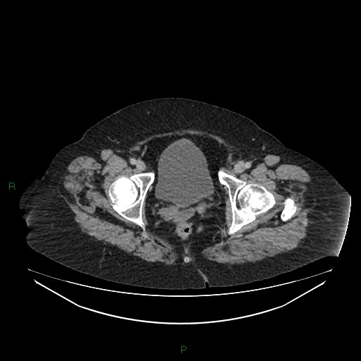 Cerebral metastasis from renal cell carcinoma (Radiopaedia 82306-96378 A 183).jpg