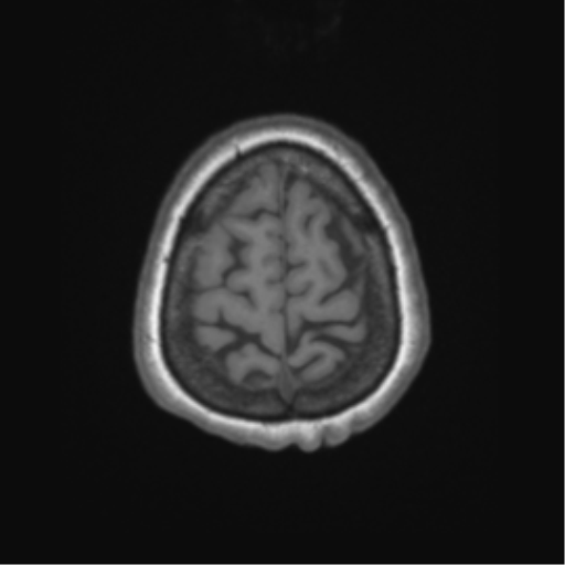 Cerebral metastasis to basal ganglia (Radiopaedia 81568-95413 Axial T1 66).png