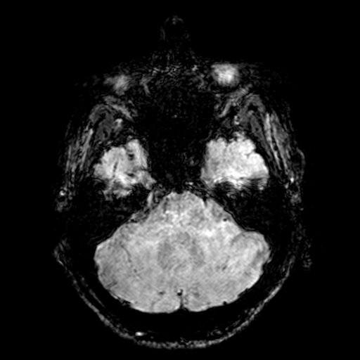 Cerebral parenchymal arteriovenous malformation (Radiopaedia 27280-27456 Axial SWI 20).jpg