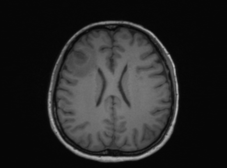 Cerebral ring enhancing lesions - cerebral metastases (Radiopaedia 44922-48817 Axial T1 193).jpg