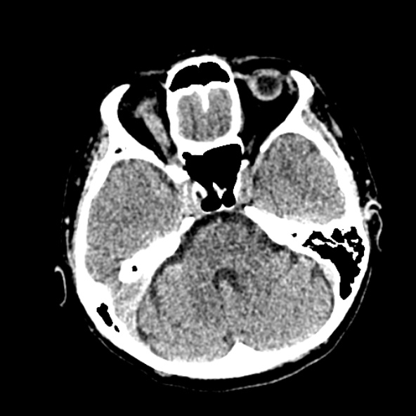 Cerebral ring enhancing lesions - cerebral metastases (Radiopaedia 44922-48818 Axial non-contrast 34).jpg