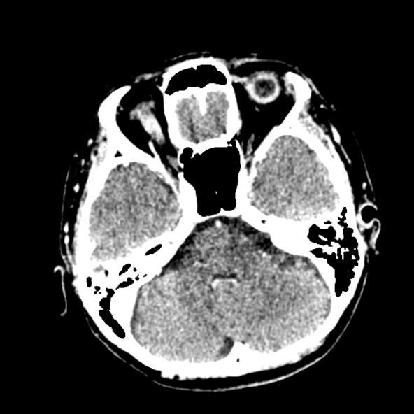 File:Cerebral ring enhancing lesions - cerebral metastases (Radiopaedia 44922-48818 B 84).jpg