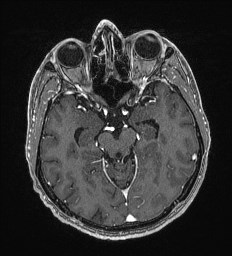 Cerebral toxoplasmosis (Radiopaedia 43956-47461 Axial T1 C+ 27).jpg