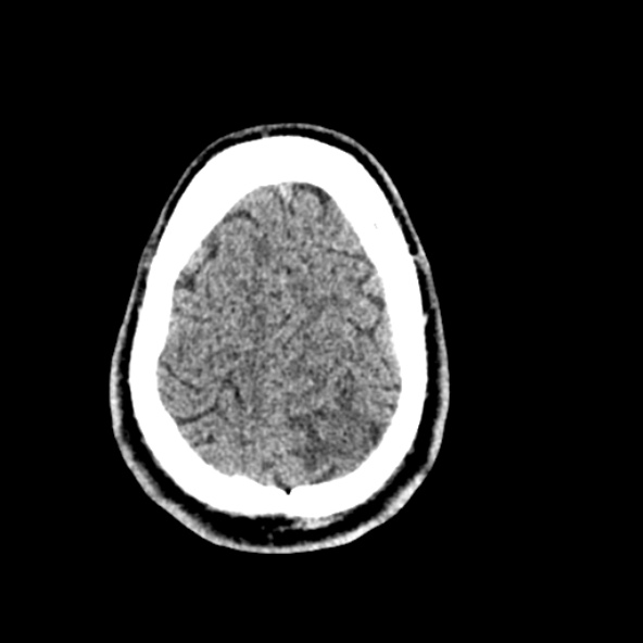 Cerebral toxoplasmosis (Radiopaedia 53993-60131 Axial non-contrast 68).jpg