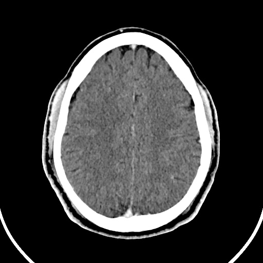 File:Cerebral venous angioma (Radiopaedia 69959-79977 B 72).jpg