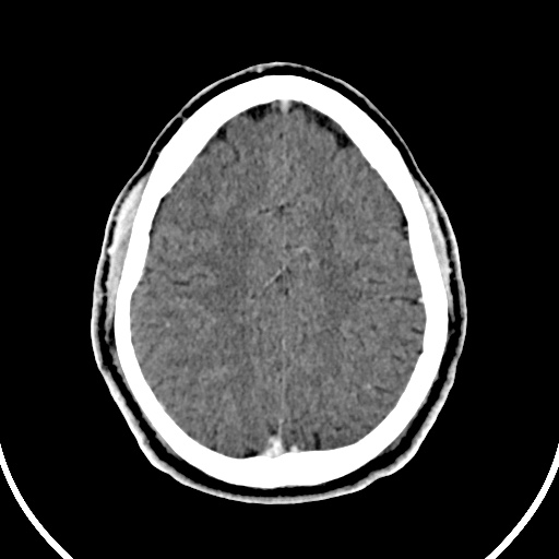 Cerebral venous angioma (Radiopaedia 69959-79977 B 76).jpg
