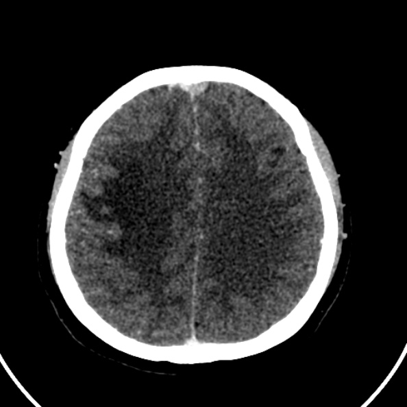 Cerebral venous hemorrhagic infarct from venous sinus thrombosis (Radiopaedia 55433-61883 Axial C+ delayed 52).jpg