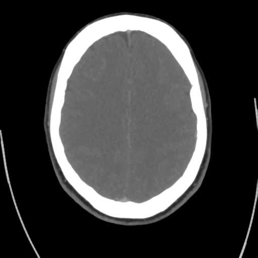 Cerebral venous infarct related to dural venous sinus thromboses (Radiopaedia 35292-36804 Axial C+ delayed 33).png