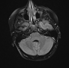 File:Cerebral venous infarction - hemorrhagic (Radiopaedia 81625-95505 Axial FLAIR 7).jpg
