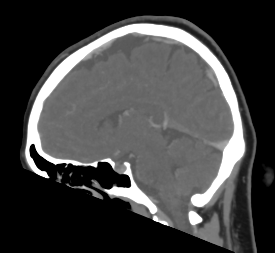 File:Cerebral venous infarction due to transverse sinus thrombosis (Radiopaedia 34688-36120 Sagittal CT venogram 30).png