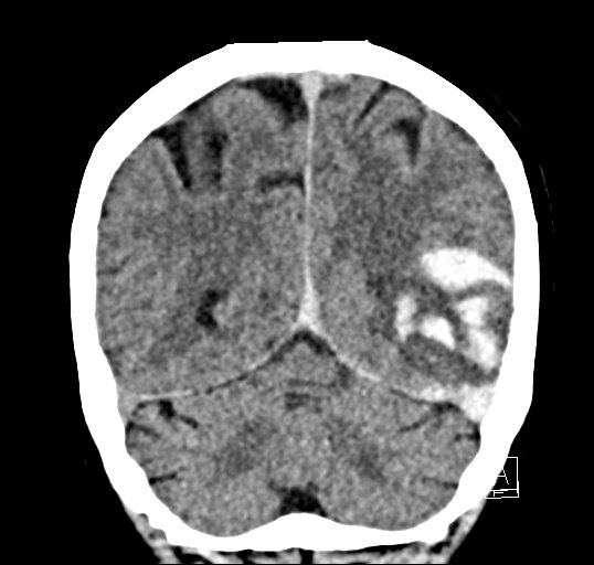 File:Cerebral venous infarction with hemorrhage (Radiopaedia 65343-74381 Coronal non-contrast 42).jpg