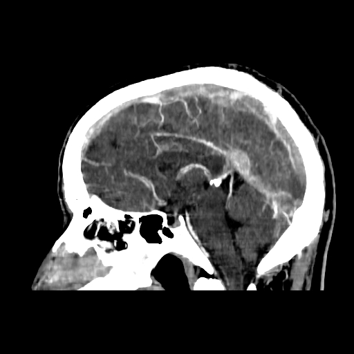 File:Cerebral venous thrombosis (CVT) (Radiopaedia 77524-89685 Sagittal CTV 22).jpg