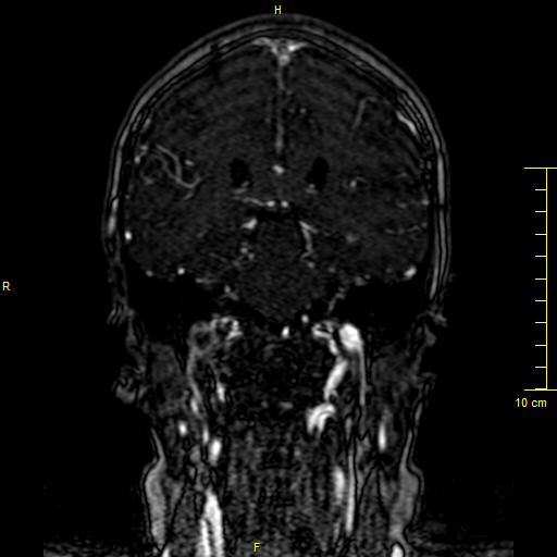 Cerebral venous thrombosis (Radiopaedia 23288-23351 MRV 95).JPG