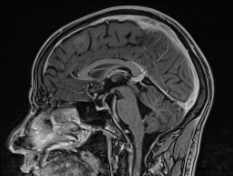 Cerebral venous thrombosis (Radiopaedia 71207-81504 Sagittal T1 C+ 31).jpg