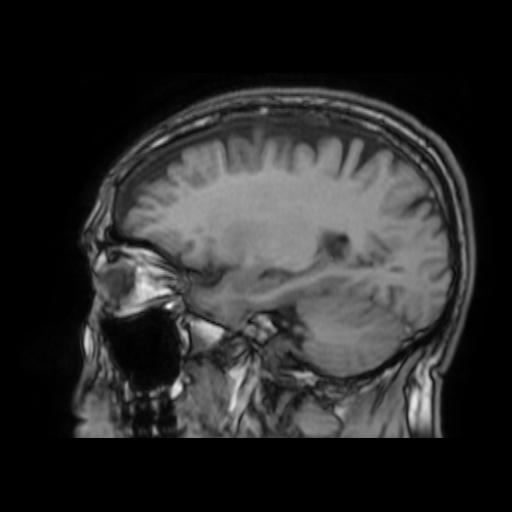 File:Cerebral venous thrombosis with secondary intracranial hypertension (Radiopaedia 89842-106957 Sagittal T1 11).jpg