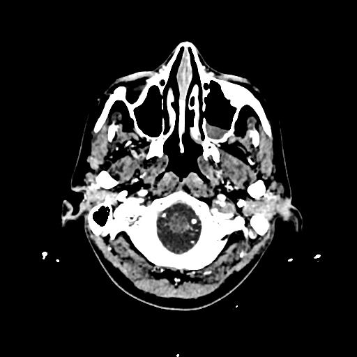 Cerebral venous thrombosis with venous hemorrhagic infarct (Radiopaedia 90354-107660 Axial with contrast 18).jpg