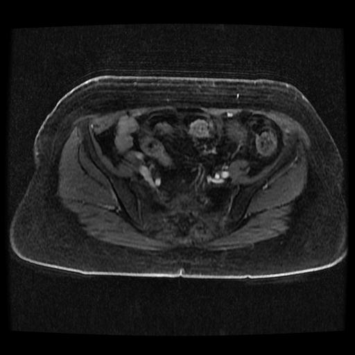 Cervical carcinoma (Radiopaedia 70924-81132 Axial T1 C+ fat sat 157).jpg