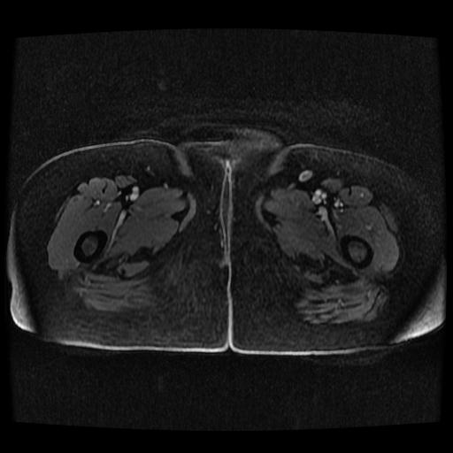 File:Cervical carcinoma (Radiopaedia 70924-81132 Axial T1 C+ fat sat 186).jpg