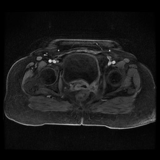 Cervical carcinoma (Radiopaedia 70924-81132 Axial T1 C+ fat sat 217).jpg