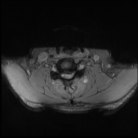 File:Cervical disc extrusion (Radiopaedia 53950-60077 Axial T2 21).jpg