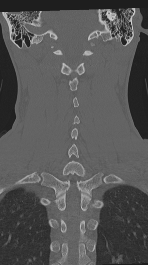 Cervical intercalary bone (Radiopaedia 35211-36748 Coronal bone window 52).png