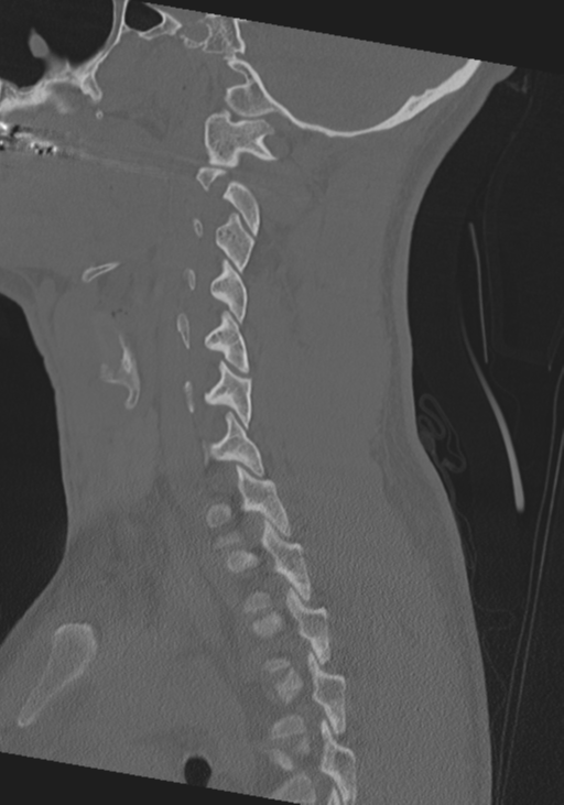 Cervical intercalary bone (Radiopaedia 35211-36748 Sagittal bone window 28).png