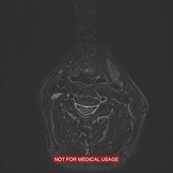 Cervical nerve schwannoma (Radiopaedia 27964-28221 C 32).jpg