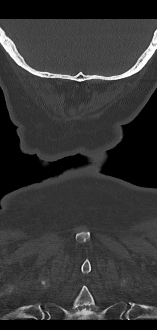 Cervical spine fracture - chalk stick (Radiopaedia 39116-41323 Coronal bone window 52).png