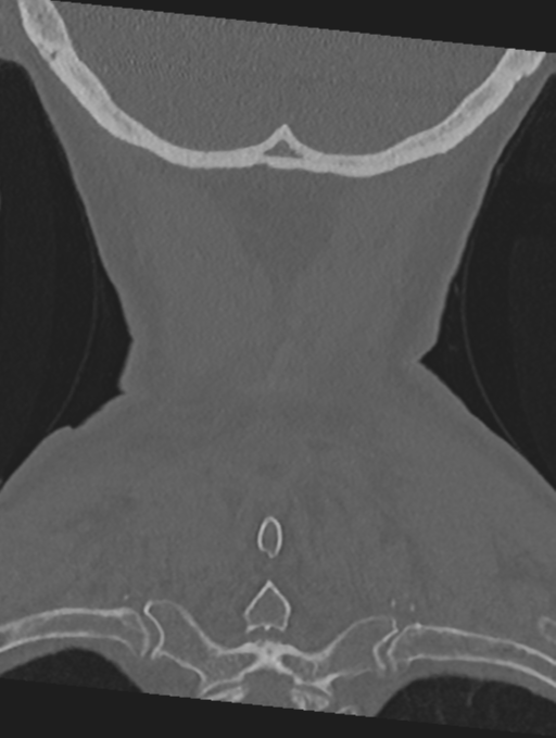 Cervical spondylolysis (Radiopaedia 49616-54811 Coronal bone window 56).png