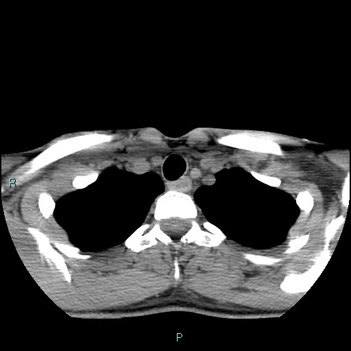 Cervical thymic cyst (Radiopaedia 88632-105335 Axial non-contrast 26).jpg