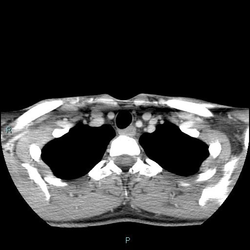 Cervical thymic cyst (Radiopaedia 88632-105335 C 27).jpg