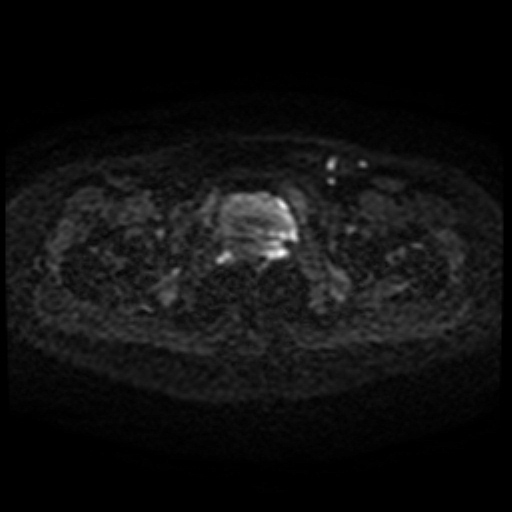 Cesarian section scar endometriosis (Radiopaedia 66520-75799 Axial DWI 71).jpg
