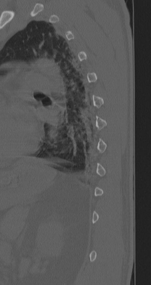 Chance fracture (Radiopaedia 33854-35020 Sagittal bone window 18).png