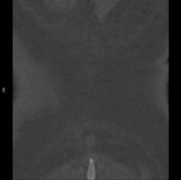 Chance fracture (Radiopaedia 36521-38081 Coronal bone window 73).jpg